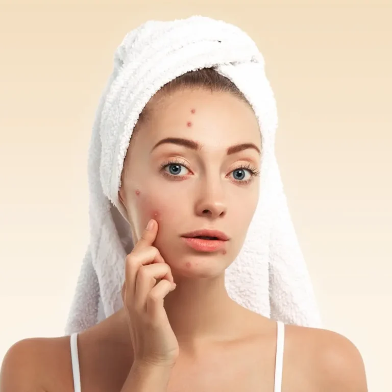 Pimples and Acne: Causes, Treatments & Home Remedies