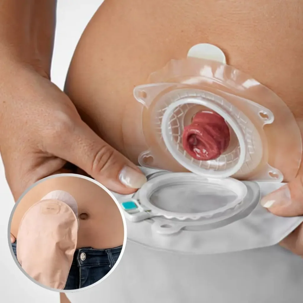 Colostomy bag change nursing procedure at home in Ranchi