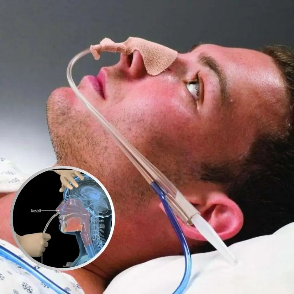 Ryle’s tube feeding nursing procedure at home in Ranchi