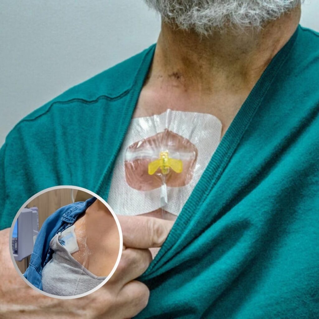 Chemo port flushing nursing procedure at home in Ranchi