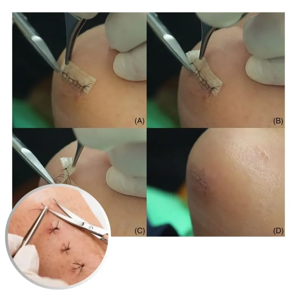 Stitch removal nursing procedure at home in Ranchi