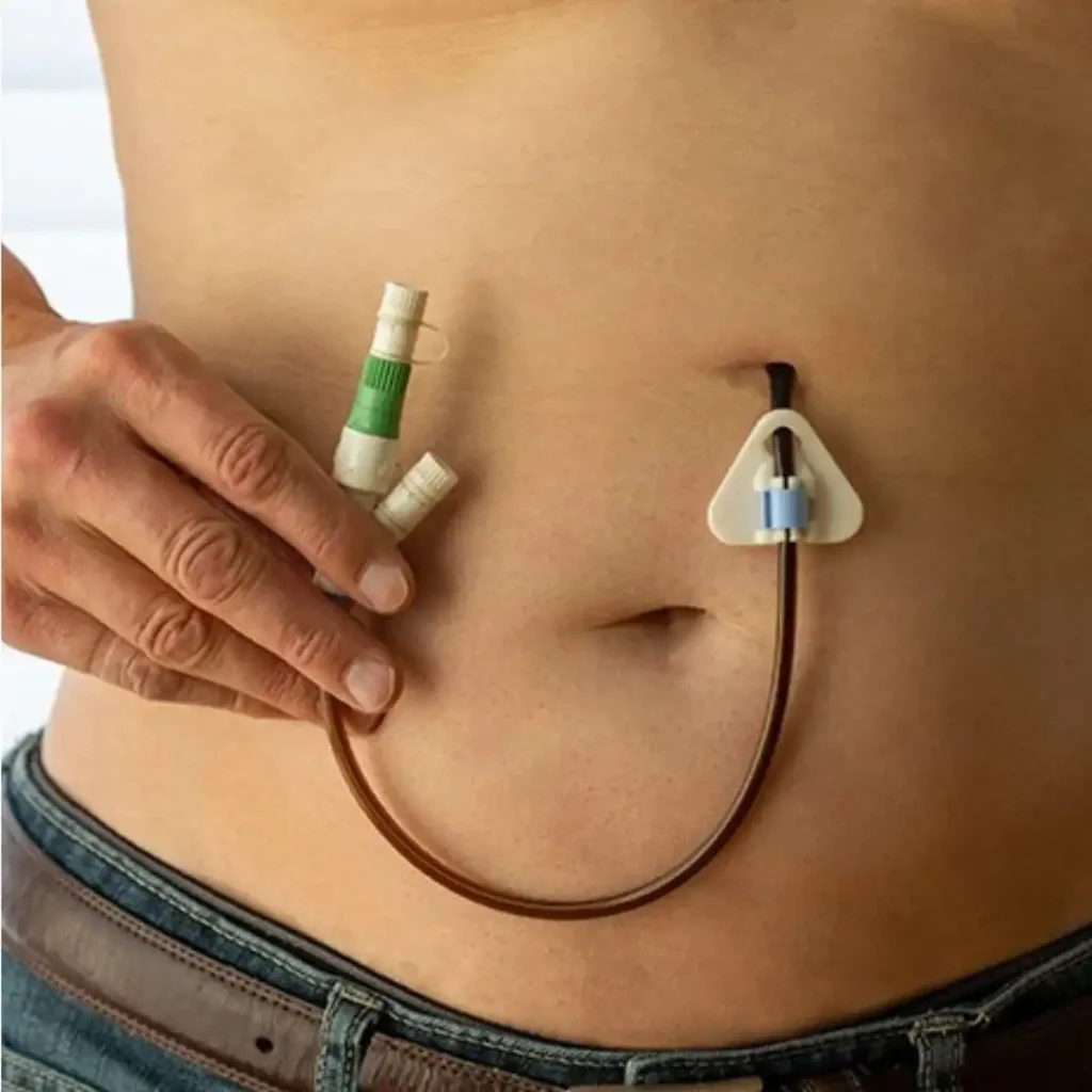 Enterostomal & PEG Tube Care